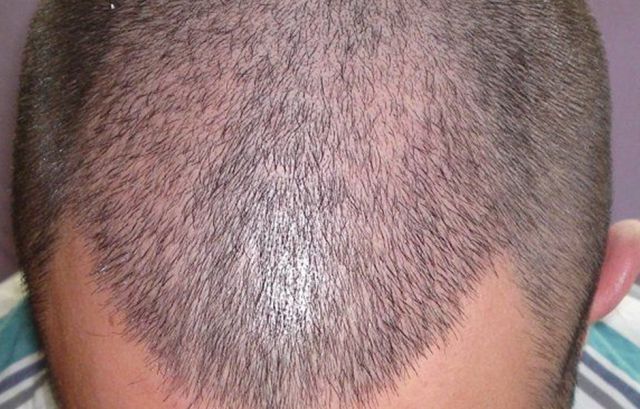 Saç Ekim Tedavisi Nedir, Etkili Bir Yöntem Mi?